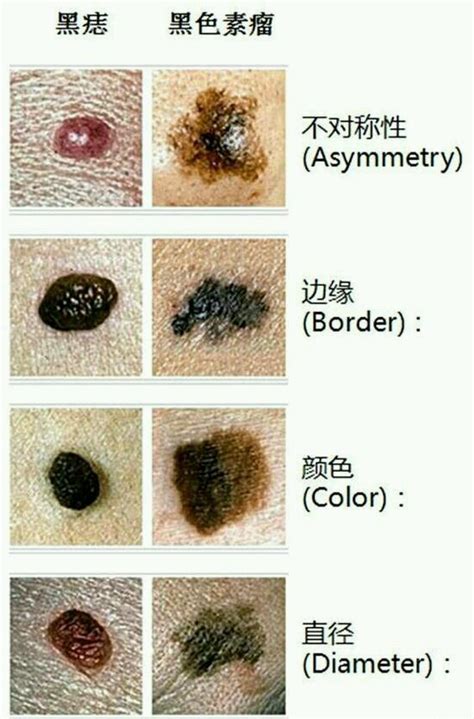 身上痣|点痣不正规可能引发癌变：关于痣的 4 个常识